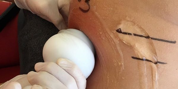 amincissement cryo21 sanary